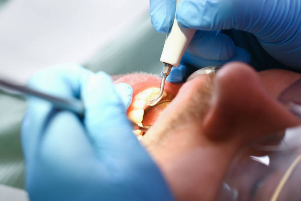 Best Emergency Root Canal Treatment in Centerville, UT